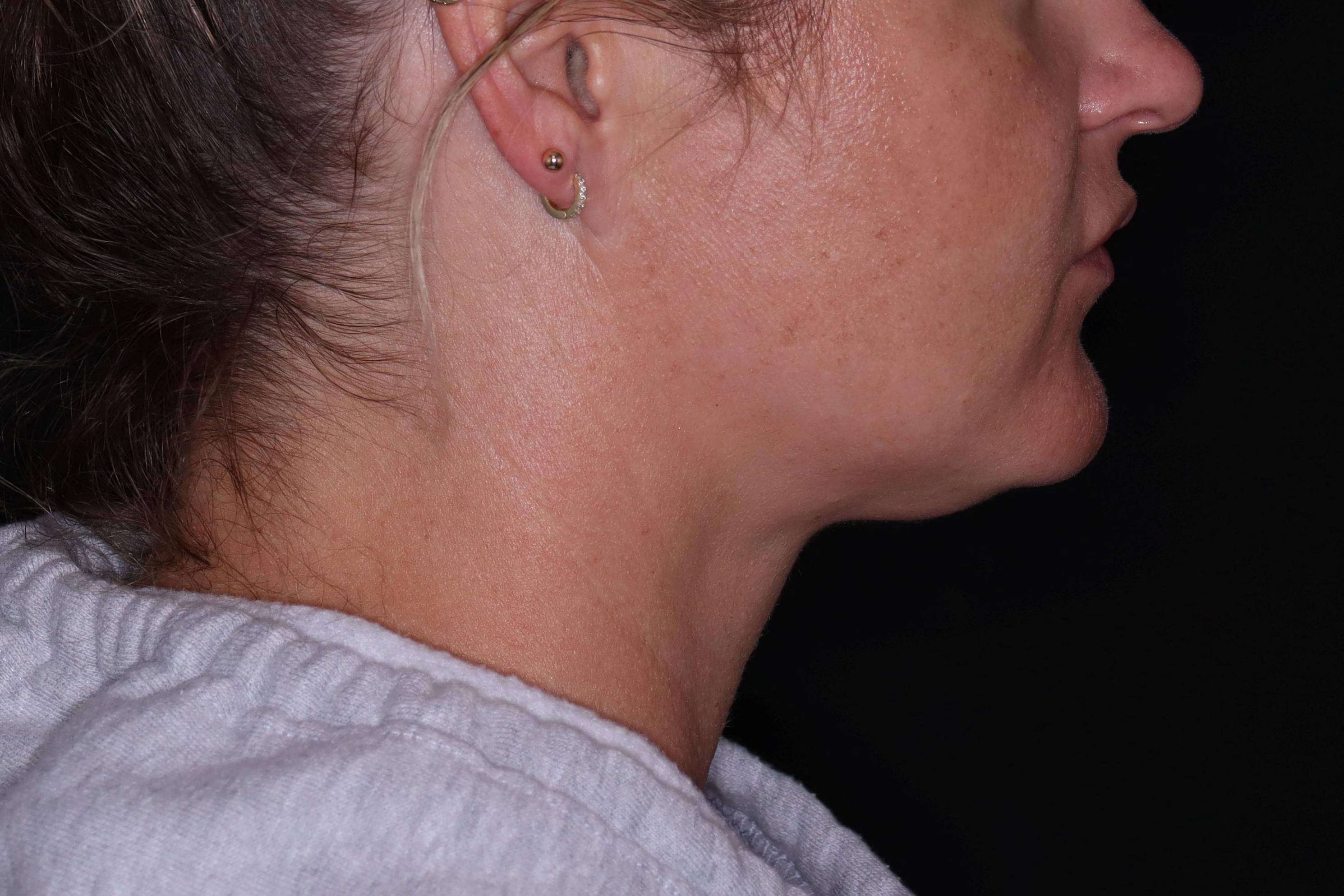 Kybella-Case #9 Before Kybella-Case #9 Before