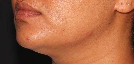Genius Acne Scars - Case #7 After