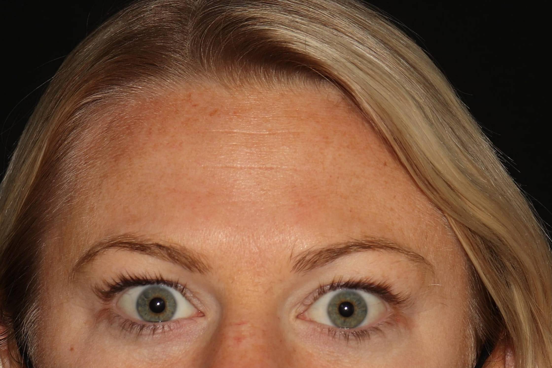 Botox - Case #11 After Botox - Case #11 After