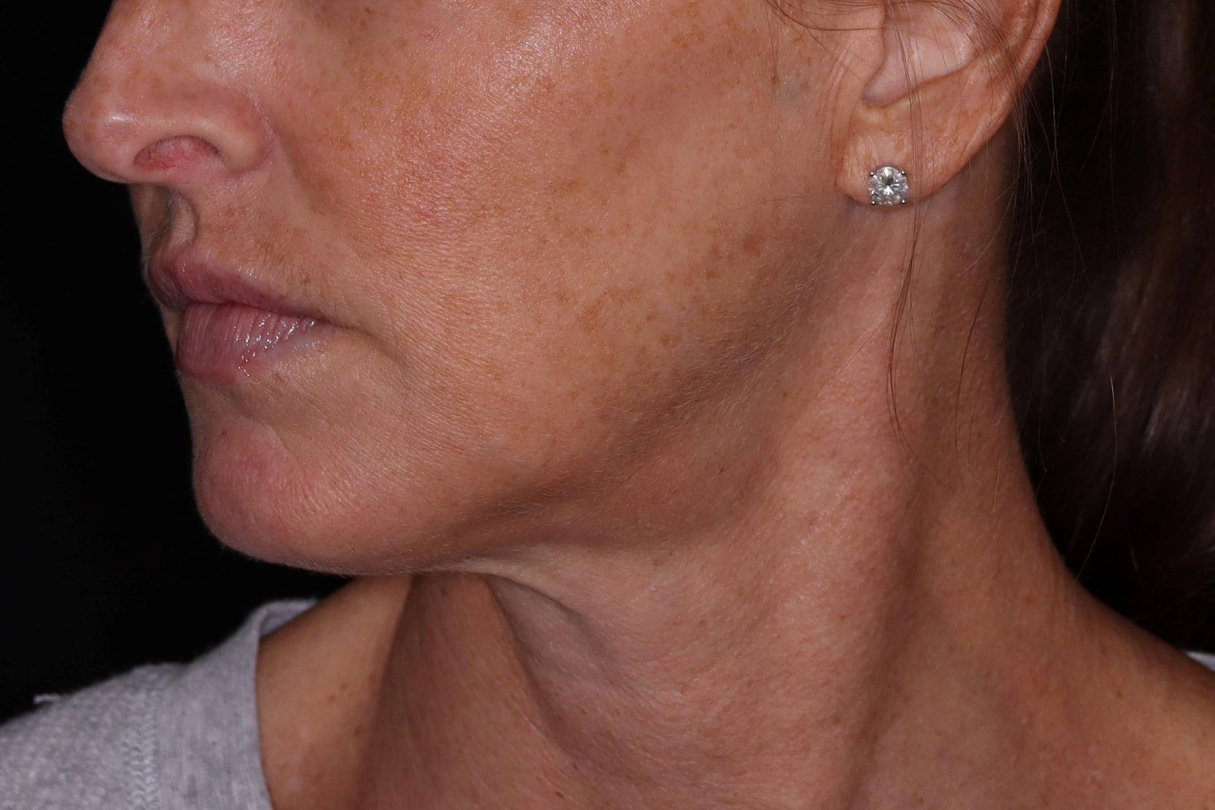 Microneedling- Case #1 Before Microneedling- Case #1 Before