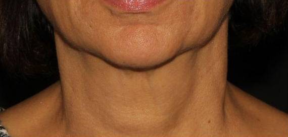 Genius Neck - Case #2 After