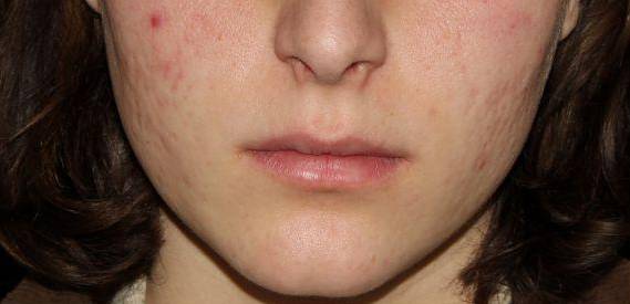 Genius Acne Scars - Case #4 Before