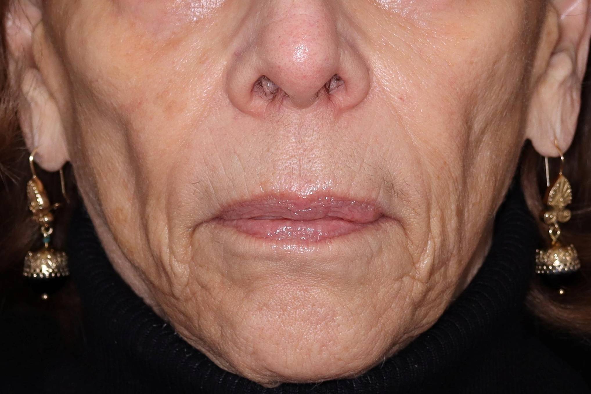 Filler Sculptra-Case #4 Before Filler Sculptra-Case #4 Before