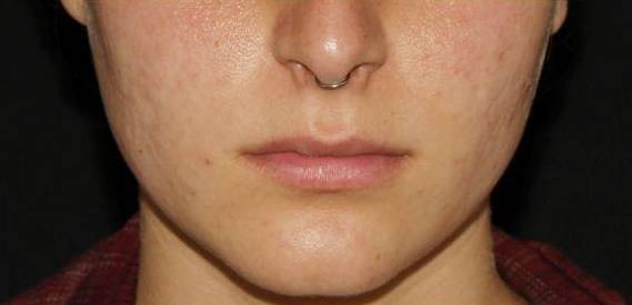 Genius Acne Scars - Case #4 After