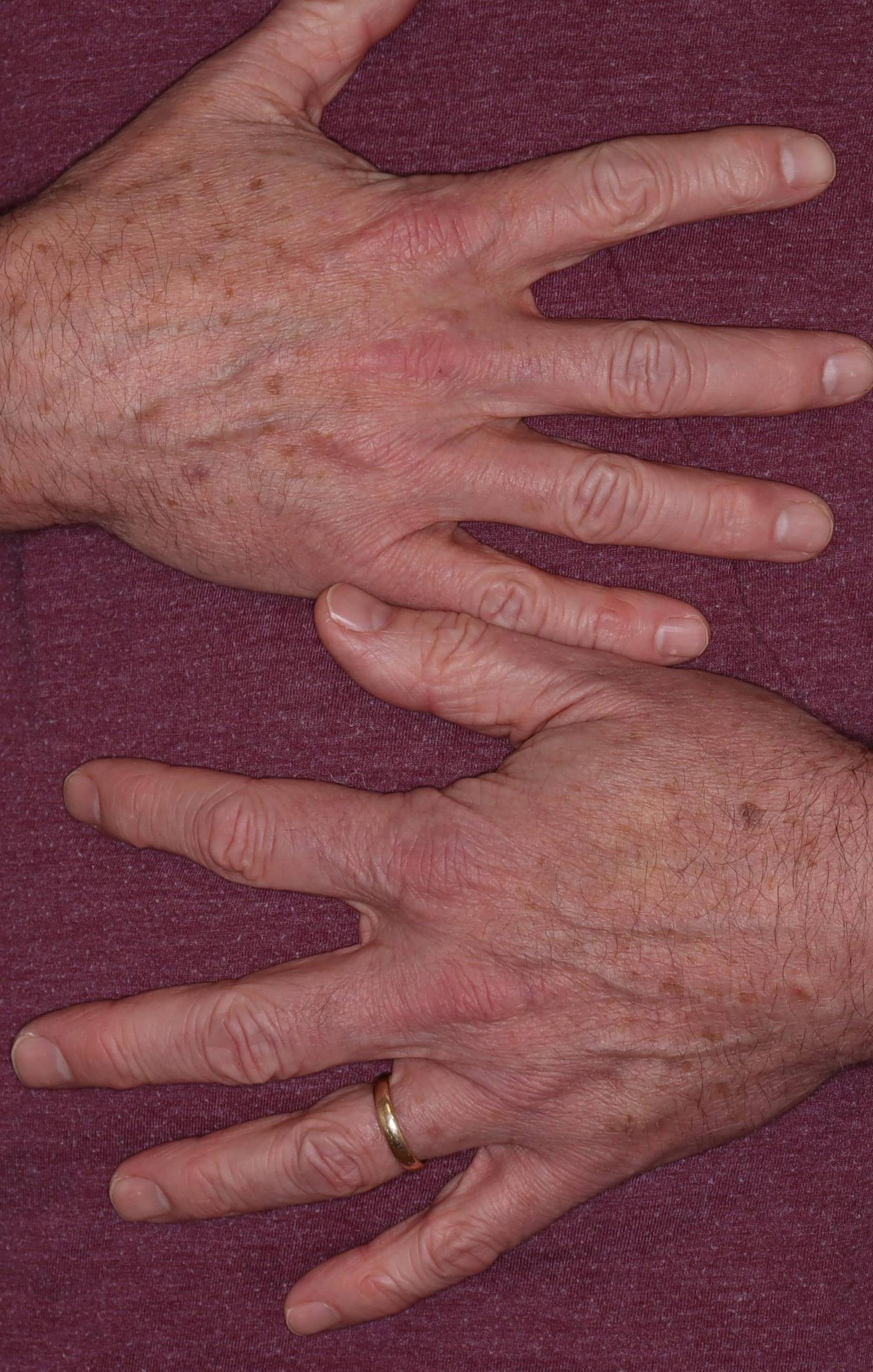 IPL Hands-Case #18 Before IPL Hands-Case #18 Before