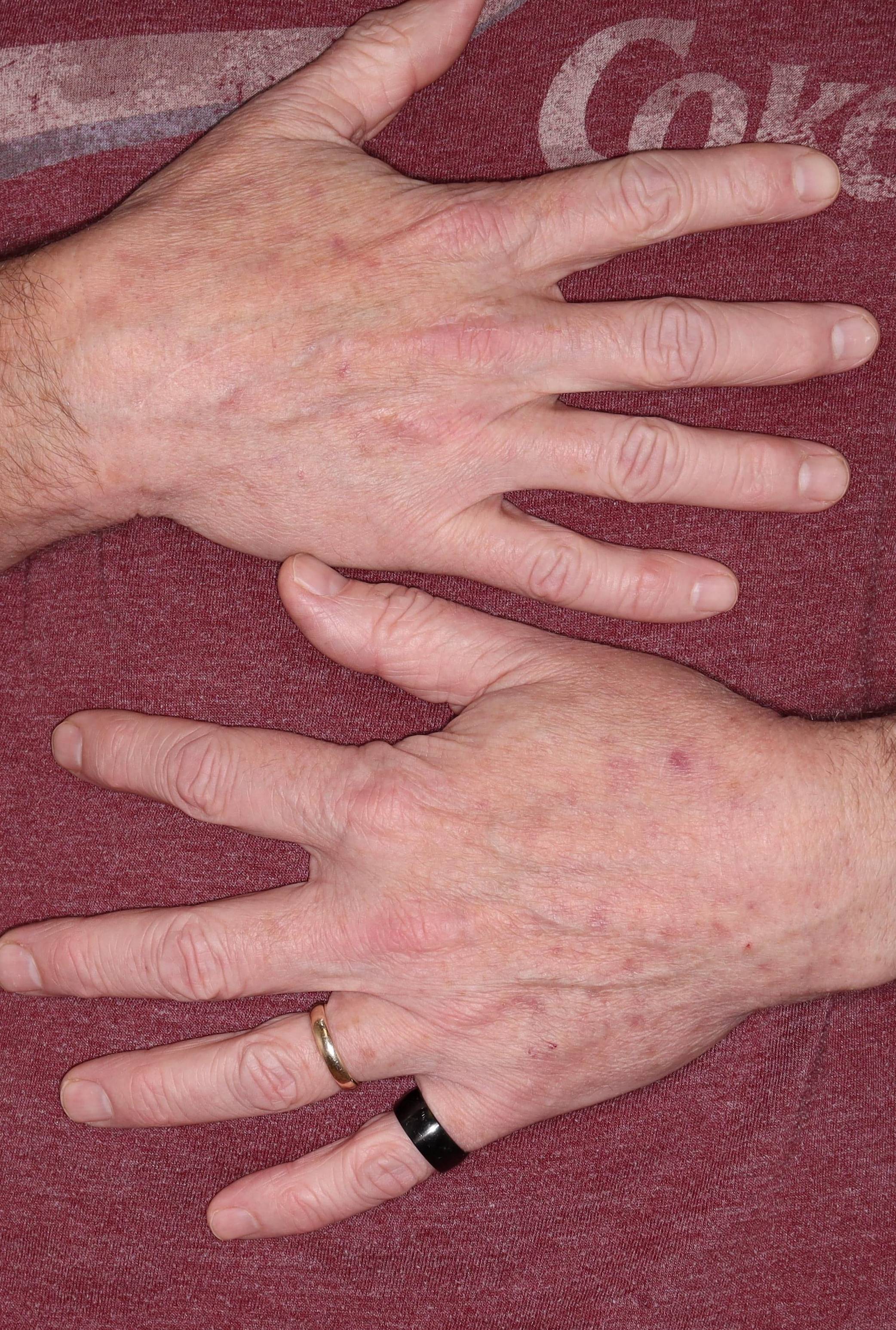 IPL Hands-Case #18 After IPL Hands-Case #18 After