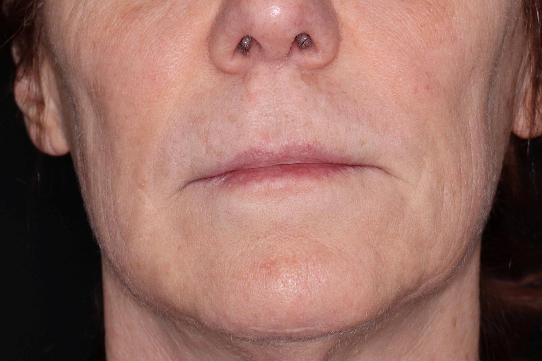 Filler Sculptra-Case #5 Before Filler Sculptra-Case #5 Before