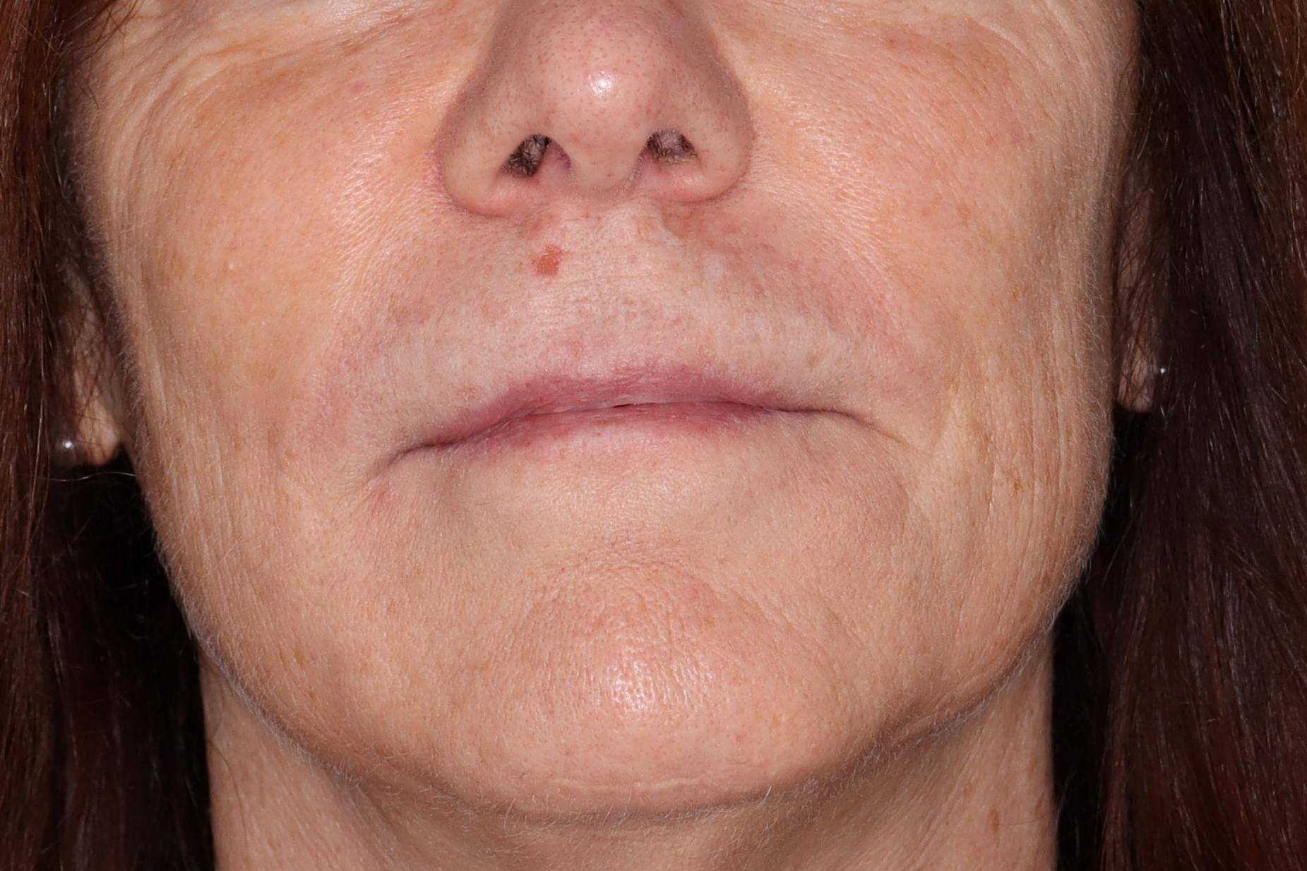 Filler Sculptra-Case #5 After Filler Sculptra-Case #5 After
