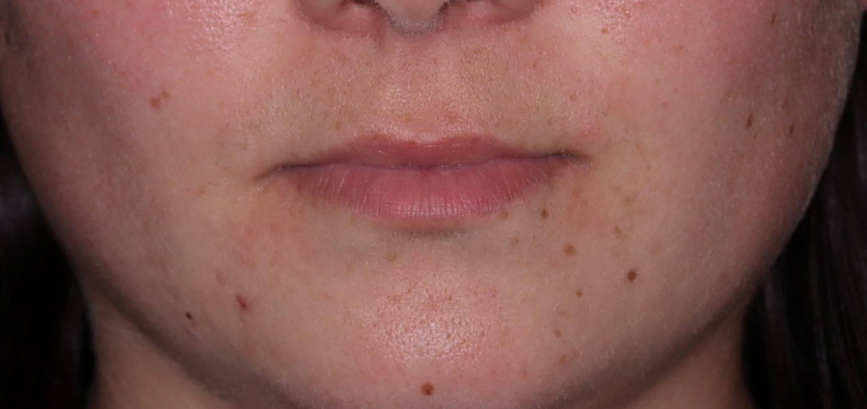 Botox-Case #12 Before Botox-Case #12 Before