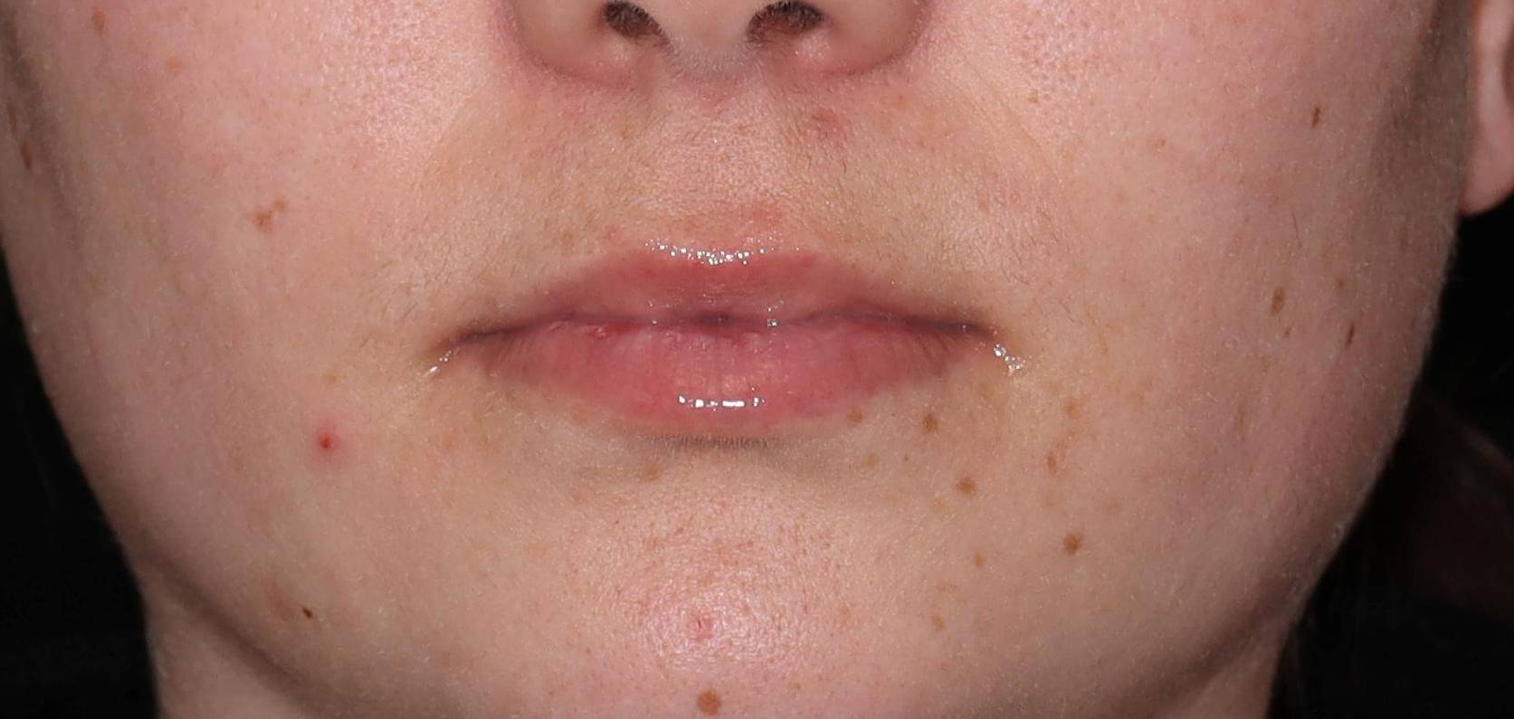 Botox-Case #12 After Botox-Case #12 After