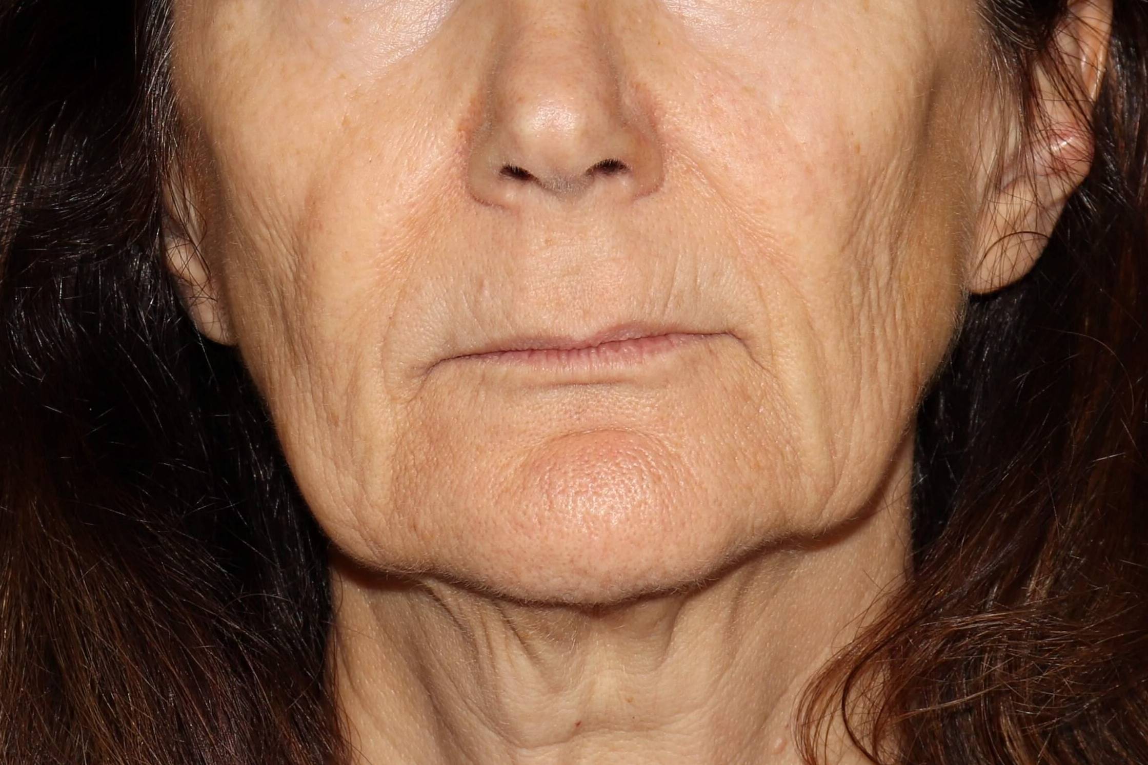Filler Sculptra-Case #2 Before Filler Sculptra-Case #2 Before