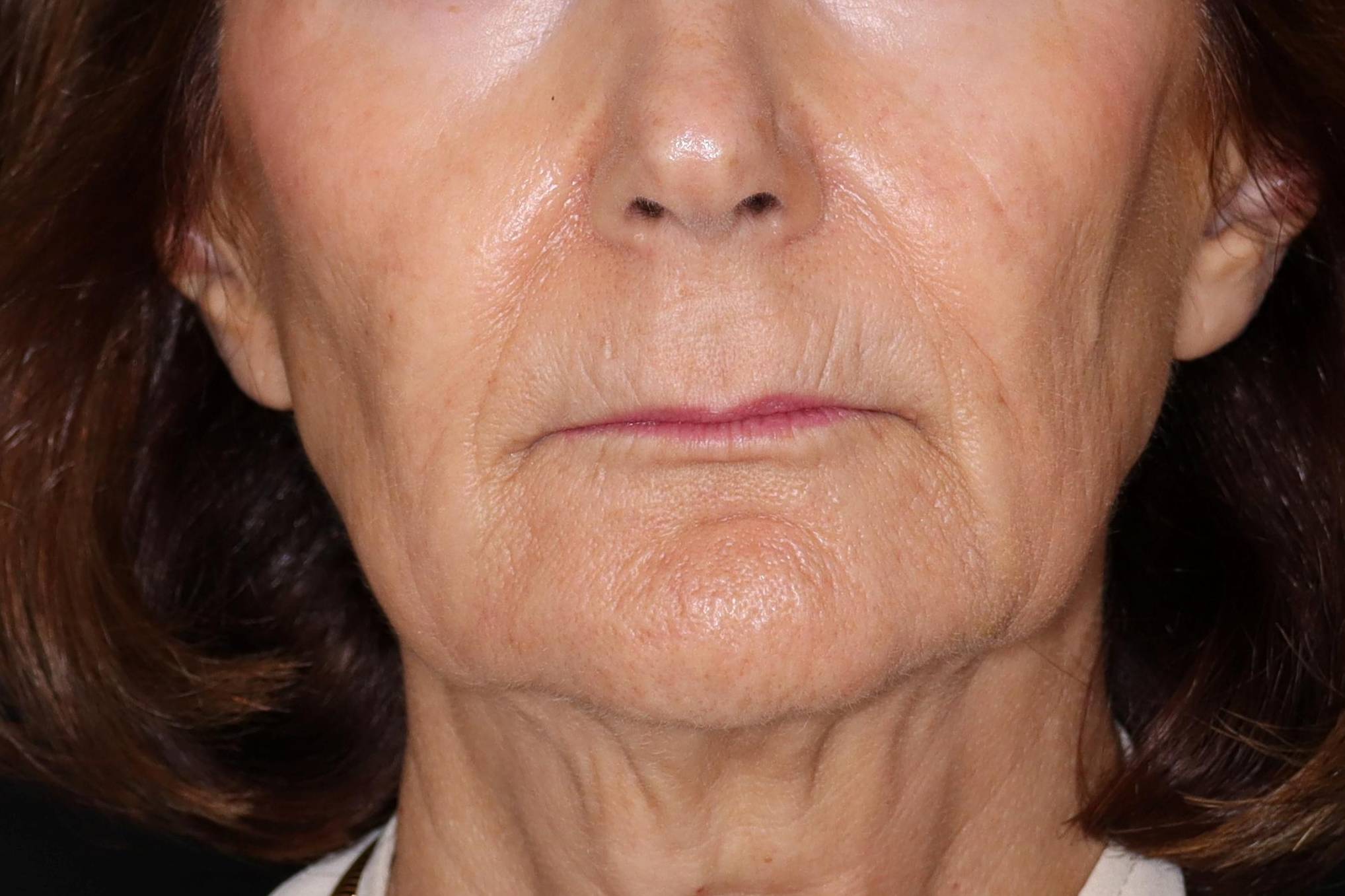Filler Sculptra-Case #2 After Filler Sculptra-Case #2 After