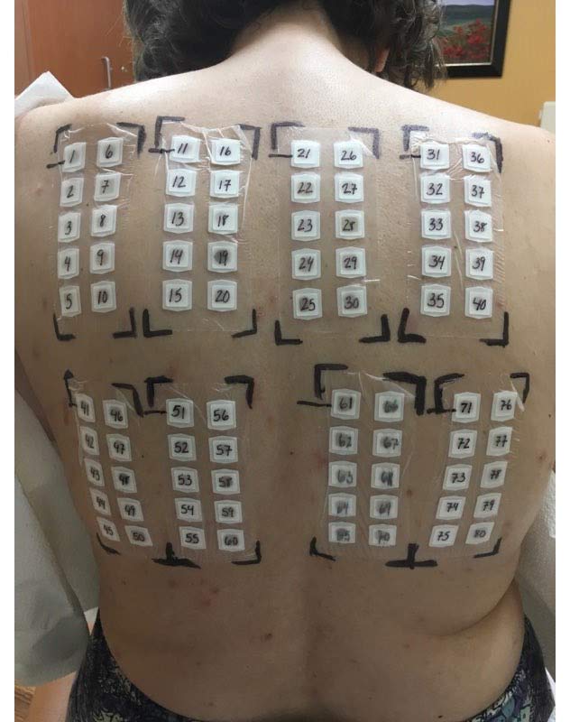 No Scratch Allergy Testing Patch Test Strips Available Dermatologist