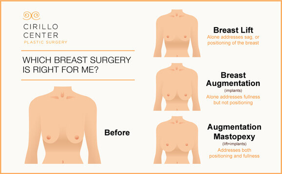 At the Cirillo Center for Plastic Surgery, mastopexy addresses both sagging and a lack of fullness. The result is shapely breasts with extra volume.