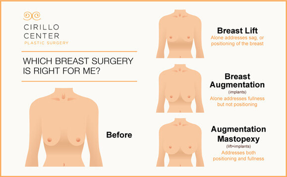 How Breast Lift Surgery Can Restore Your Droopy Breasts