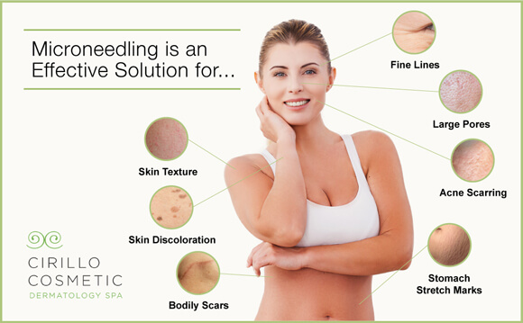 Cirillo Cosmetic Dermatology Spa offers microneedling to treat a wide range of cosmetic skin conditions.