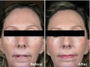 Laser Skin resurfacing