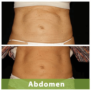 emsculpt abdomen