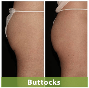 emsculpt buttock