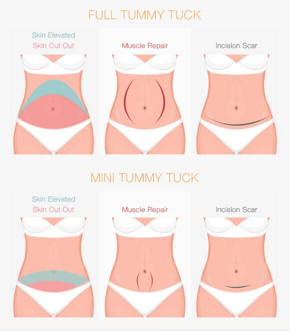 Choose from either a full or mini tummy tuck at Bryn Mawr and Newtown Square's Cirillo Center for Plastic Surgery.