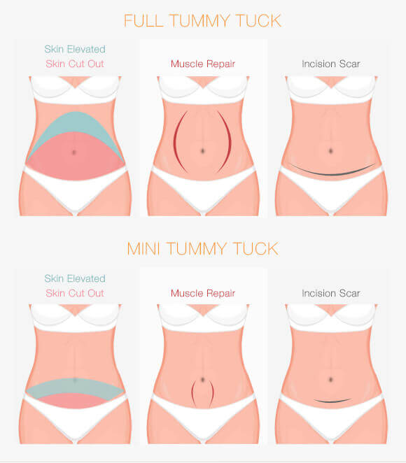 Mini Tummy Tuck Results  Cosmetic Plastic Surgery Institute