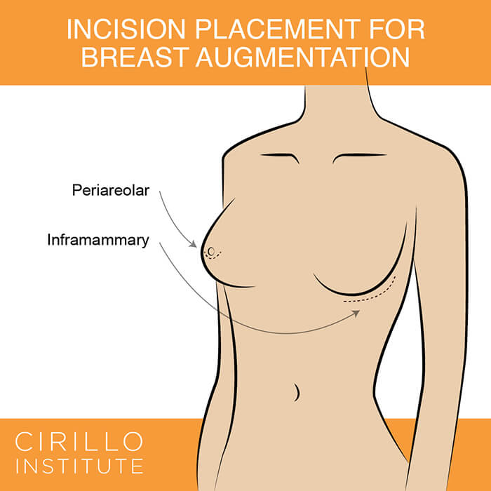 Learn about the two incision options for breast augmentation at the Philadelphia area’s Cirillo Center for Plastic Surgery.
