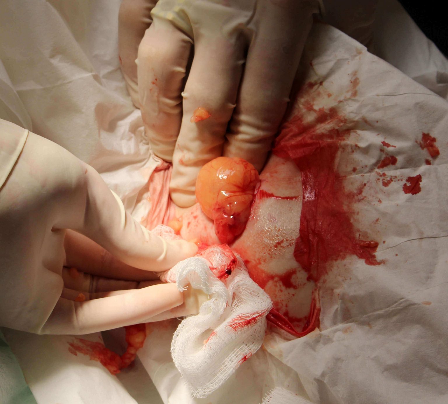 Lipoma Removal