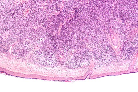 Merkel Cell Carcinoma