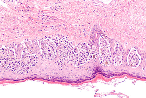 Melanoma in situ