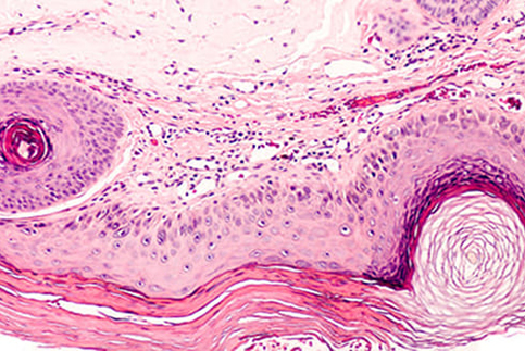 Actinic Keratosis- - actinic-keratosis-path (3)