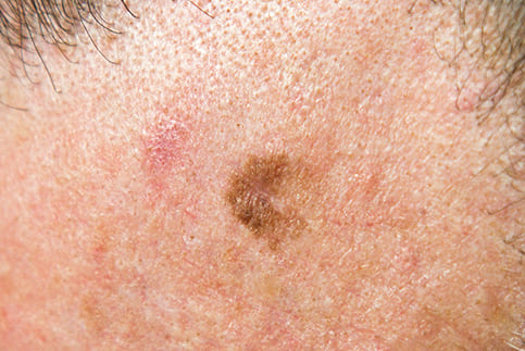 Melanoma in situ