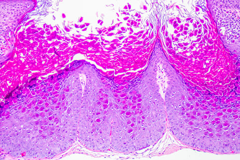 Molluscum Contagiosum