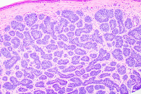 Basal Cell Carcinoma