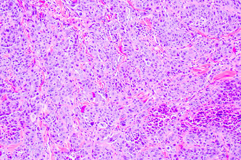 Squamous Cell Carcinoma