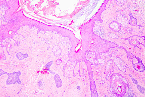 Trichofolliculoma