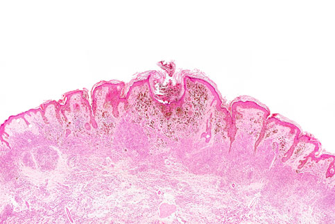 Metastatic Melanoma