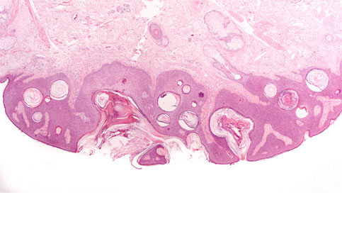 Seborrheic Keratoses