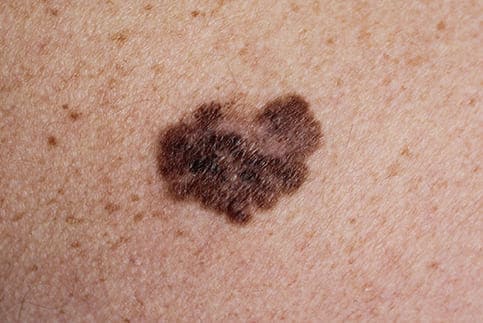 Metastatic Melanoma