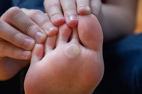 Plantar Wart