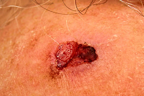 Squamous Cell Carcinoma