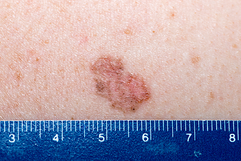 Basal Cell Carcinoma