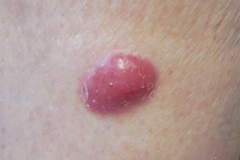 Merkel Cell Carcinoma