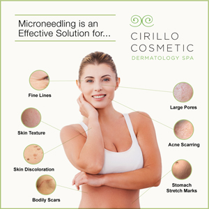 Cirillo Cosmetic Dermatology Spa offers microneedling to treat a wide range of cosmetic skin conditions.