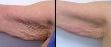 Before and After underarm fat treatment