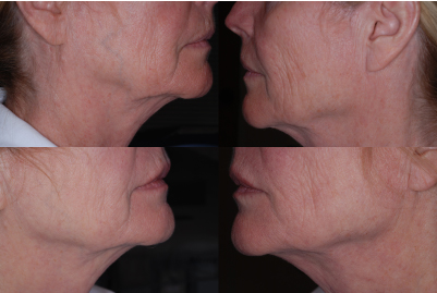 jowls treatment Philadelphia