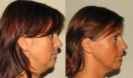 Before and after neck fat treatments