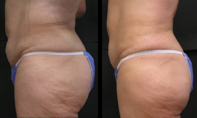 Before and after fat lose treatments