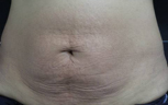 after image of stretch marks treatment