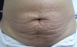 before stretch marks treatment