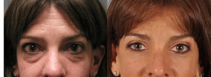 under-eye lid treatments